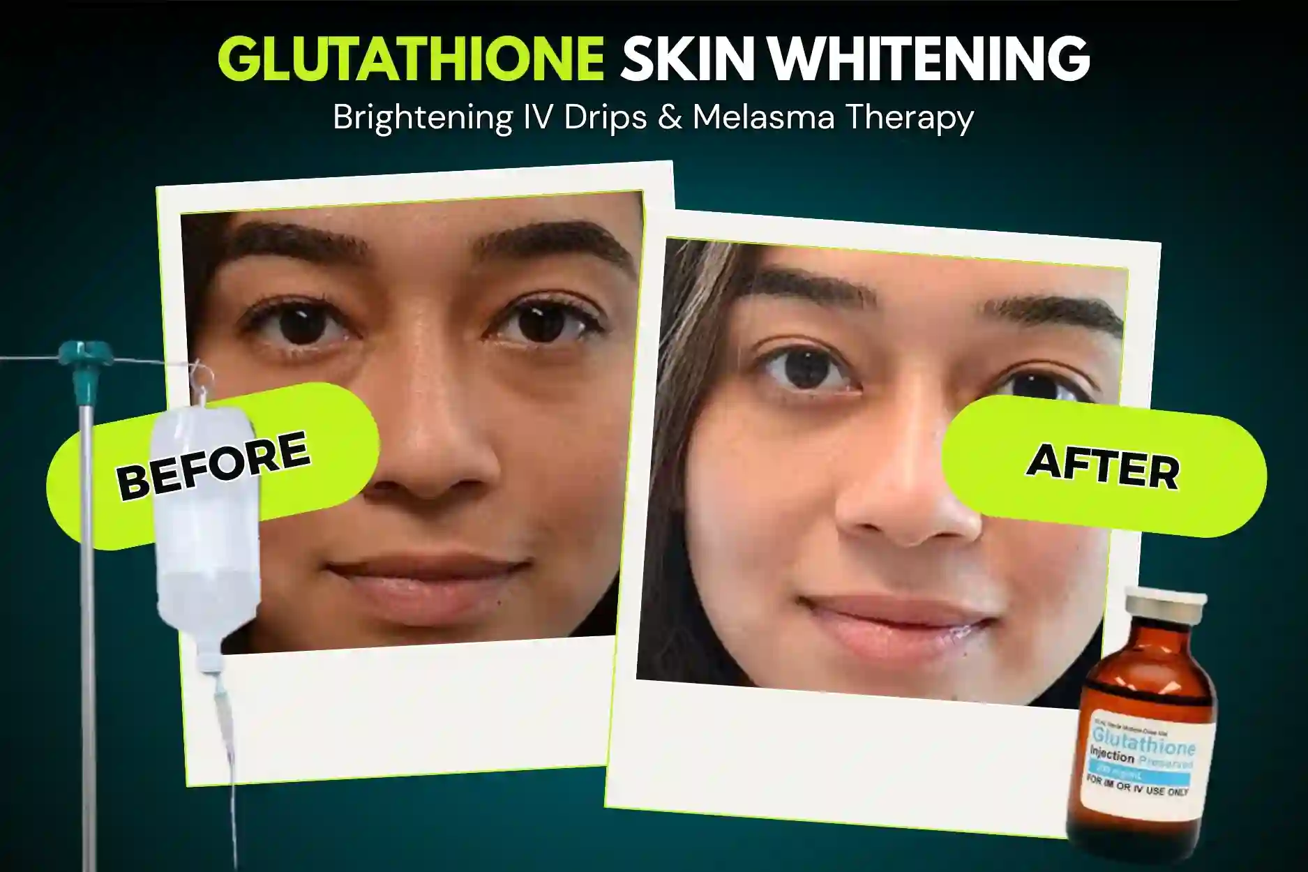Glutathione Skin Whitening Before and After Results - SMC Aesthetics Karachi